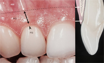 歯と歯茎のバランス
