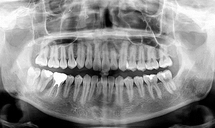 歯周病の進行度を把握する「レントゲン検査」